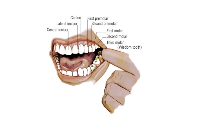 Cracked wisdom teeth