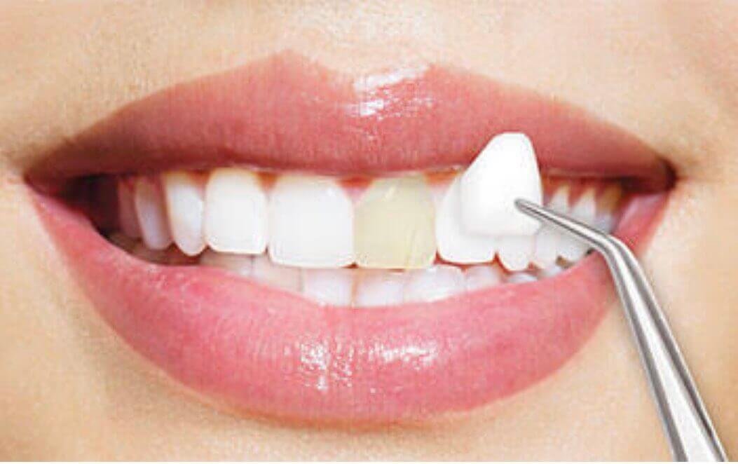 Dental veneers