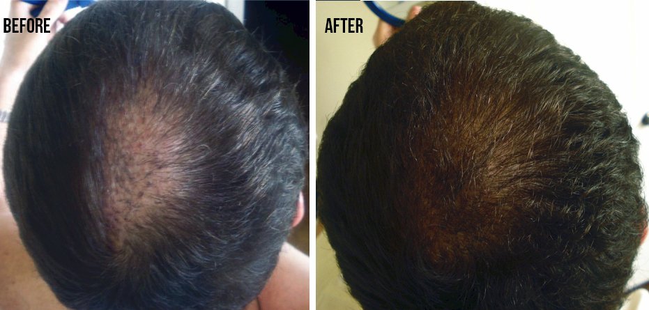 PRP Hair Treatment