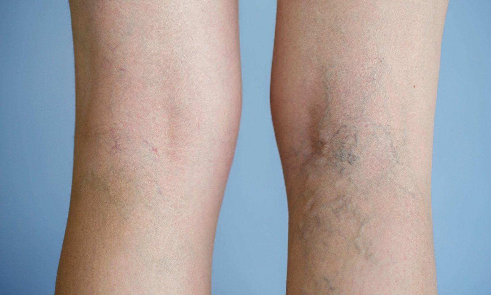 Sclerotherapy