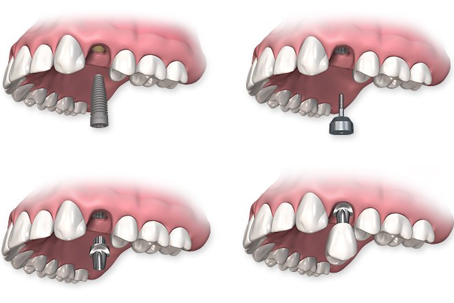 Single Tooth Replacement