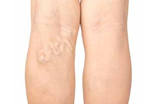 Treatment of varicose veins