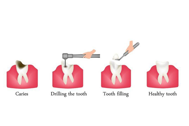 dental filling