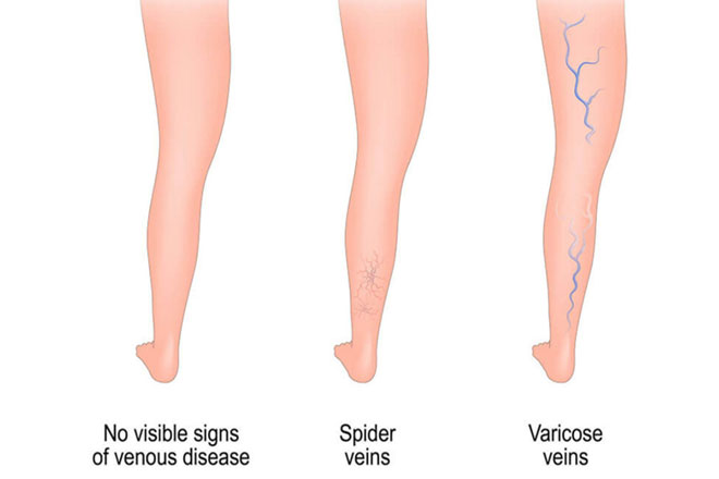spider-veins