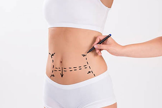 Body-Liposuction