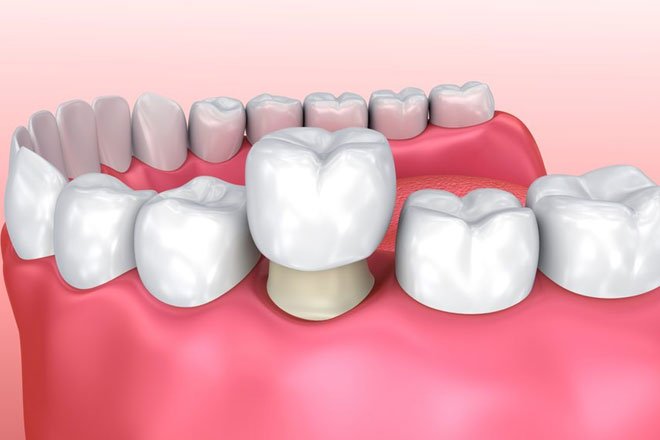 dental crown