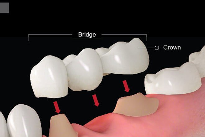 dental-bridge-procedure