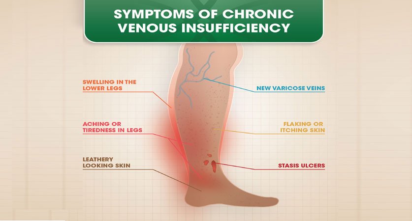 Chronic Venous Insufficiency