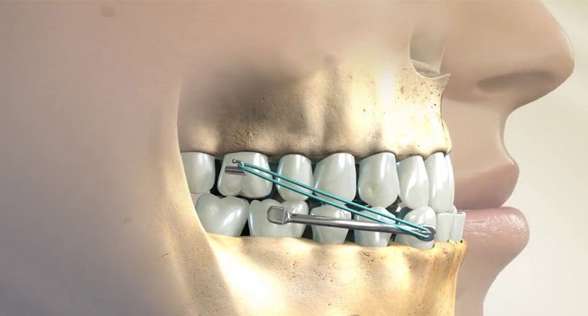 fix underbite