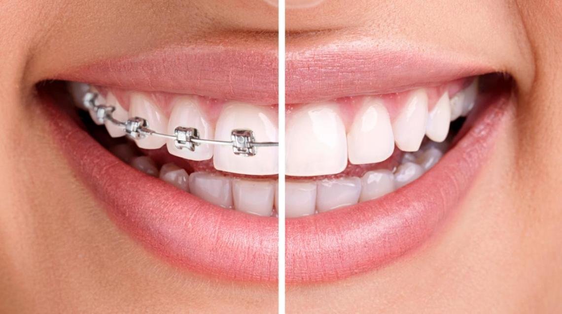 Dental Braces