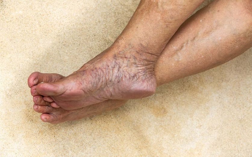 What Kind of Doctor Treats Varicose Veins