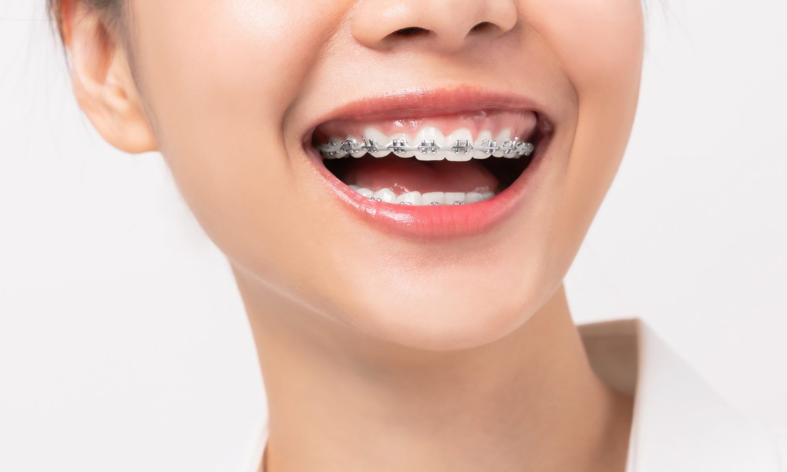 best braces colors