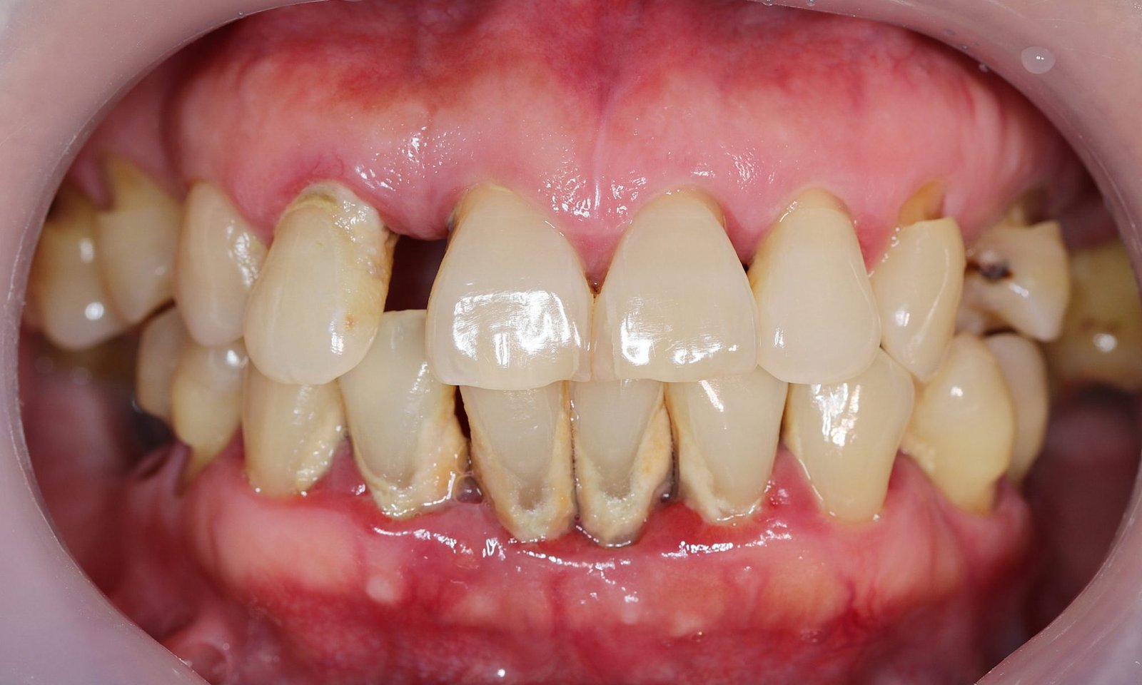 periodontitis