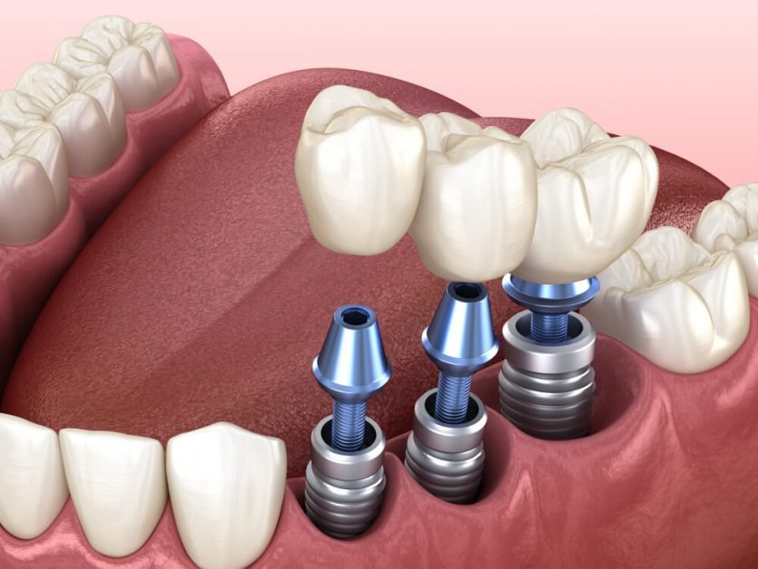 Dental Implants