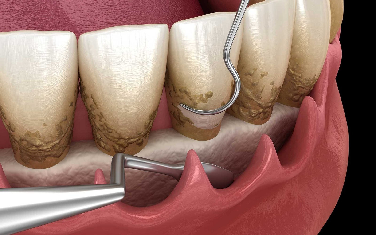 deep cleaning teeth