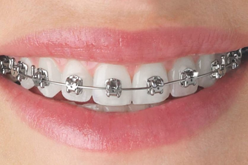 How long put braces