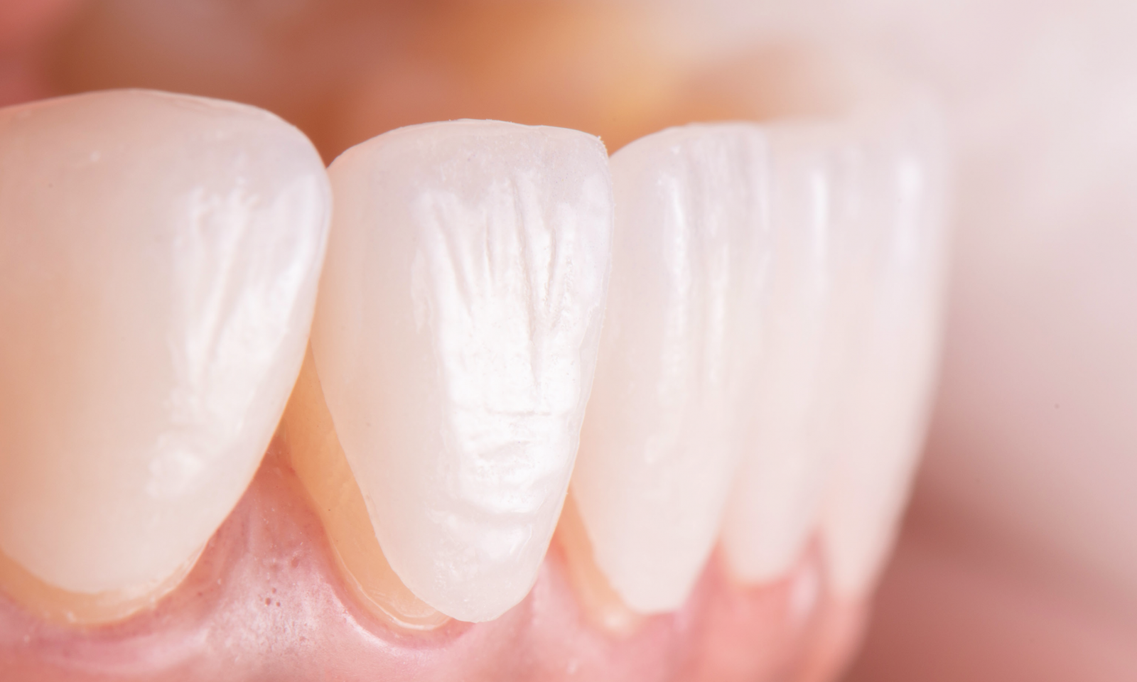 Dental Veneers