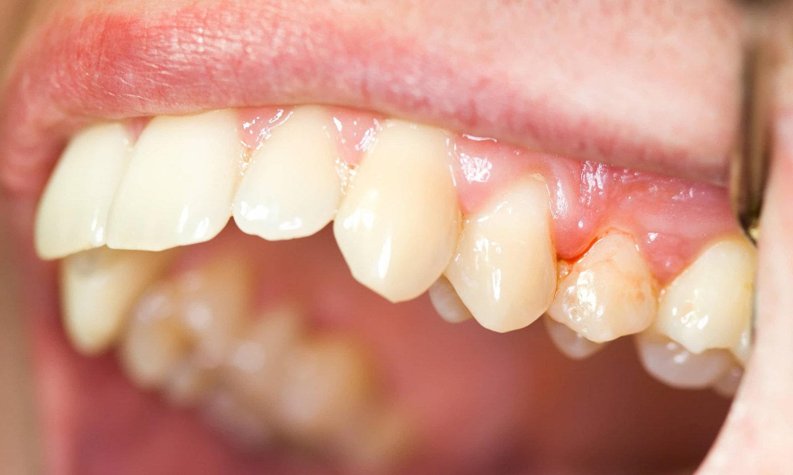 Gingivitis Treatment