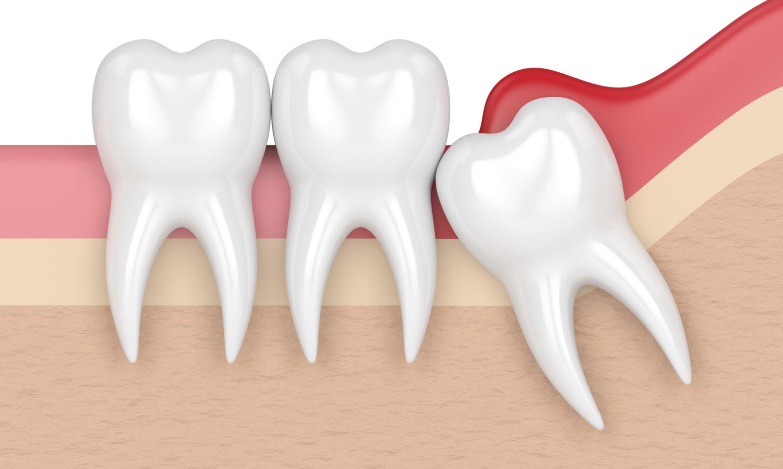 Wisdom Teeth Extraction