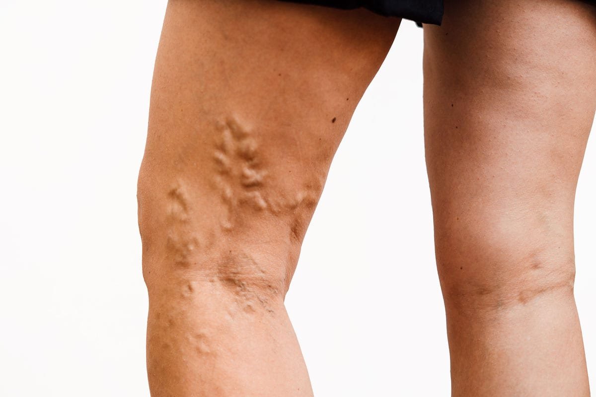 Varicose Veins