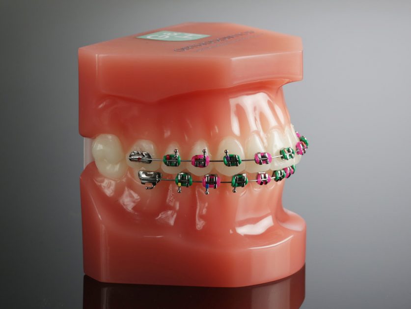 comfort dental braces