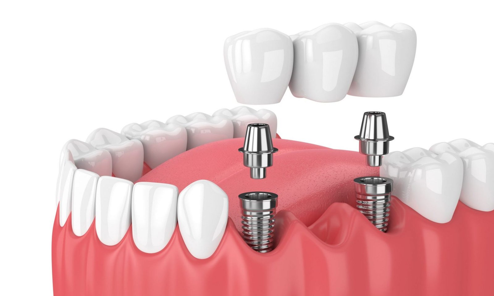 dental implant