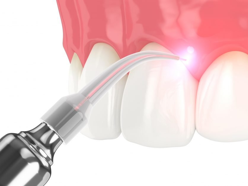 Laser Dentistry