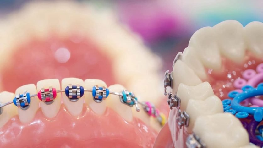 braces colors