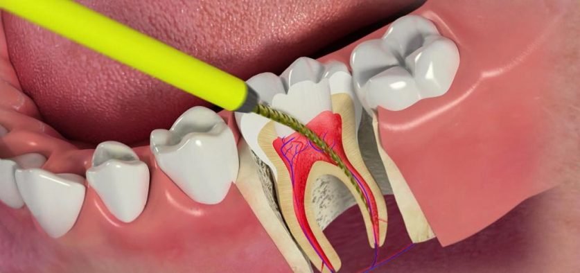 Root Canal Treatment