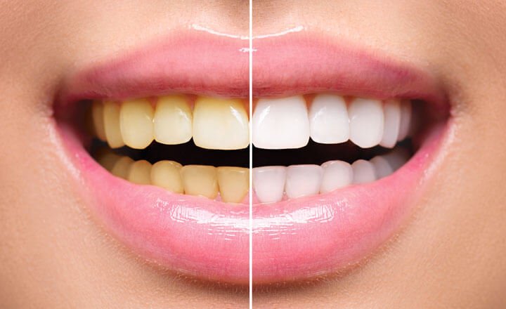 Teeth Bleaching