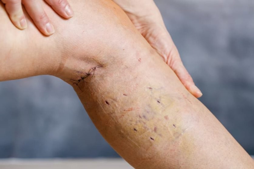 Symptoms Of Varicose Veins