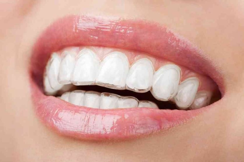 Benefits Of Invisalign