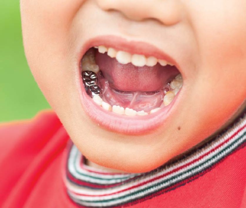 Dental Crowns For Children