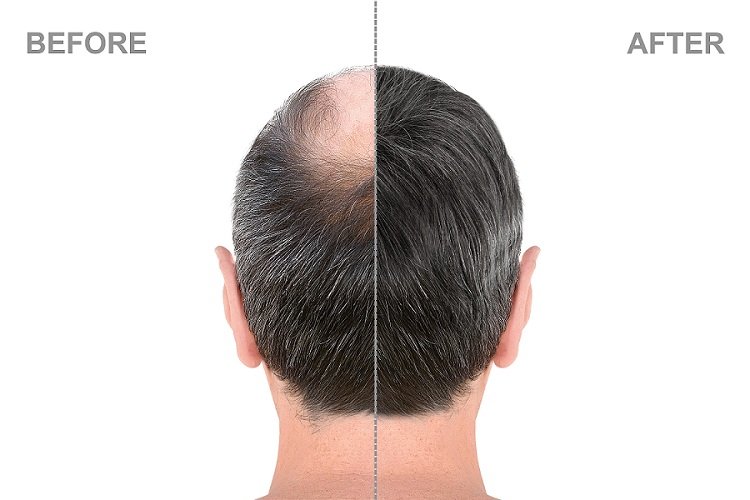 hair transplant