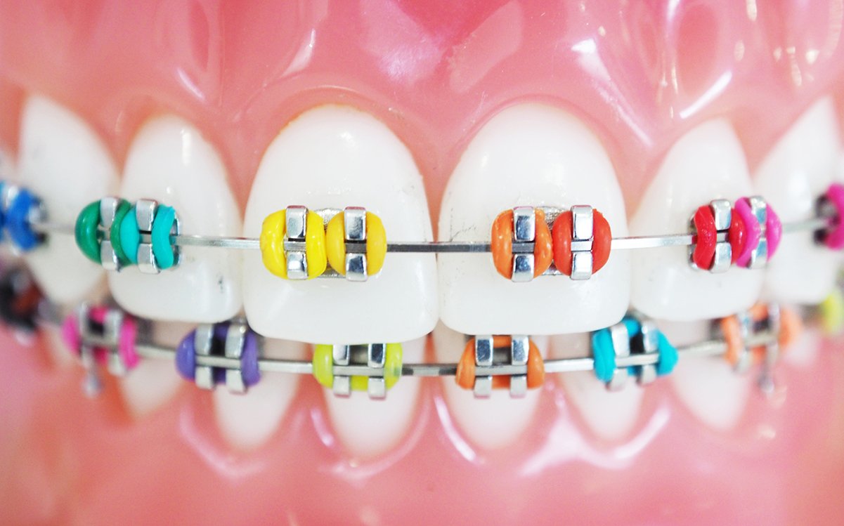 Braces Color