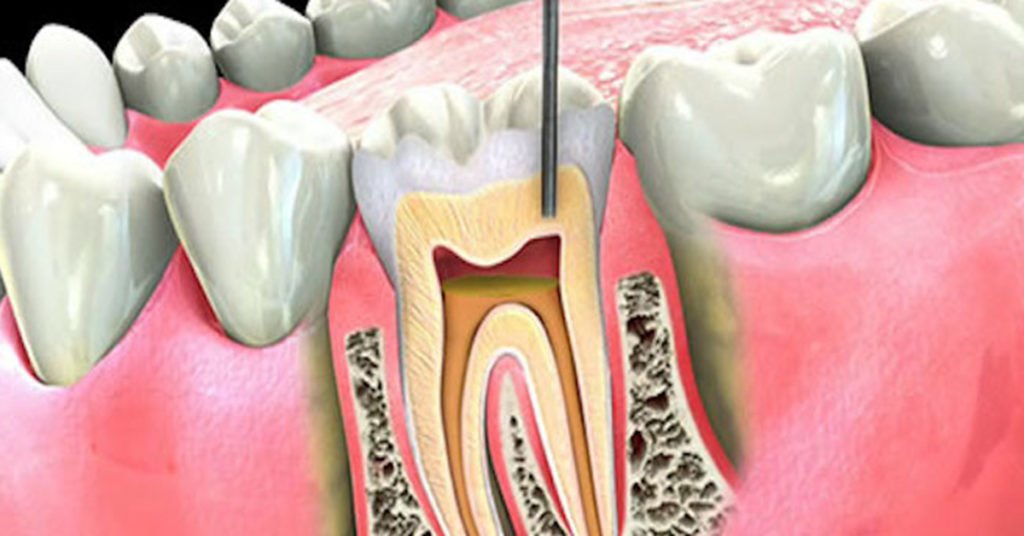 Root Canal Treatment