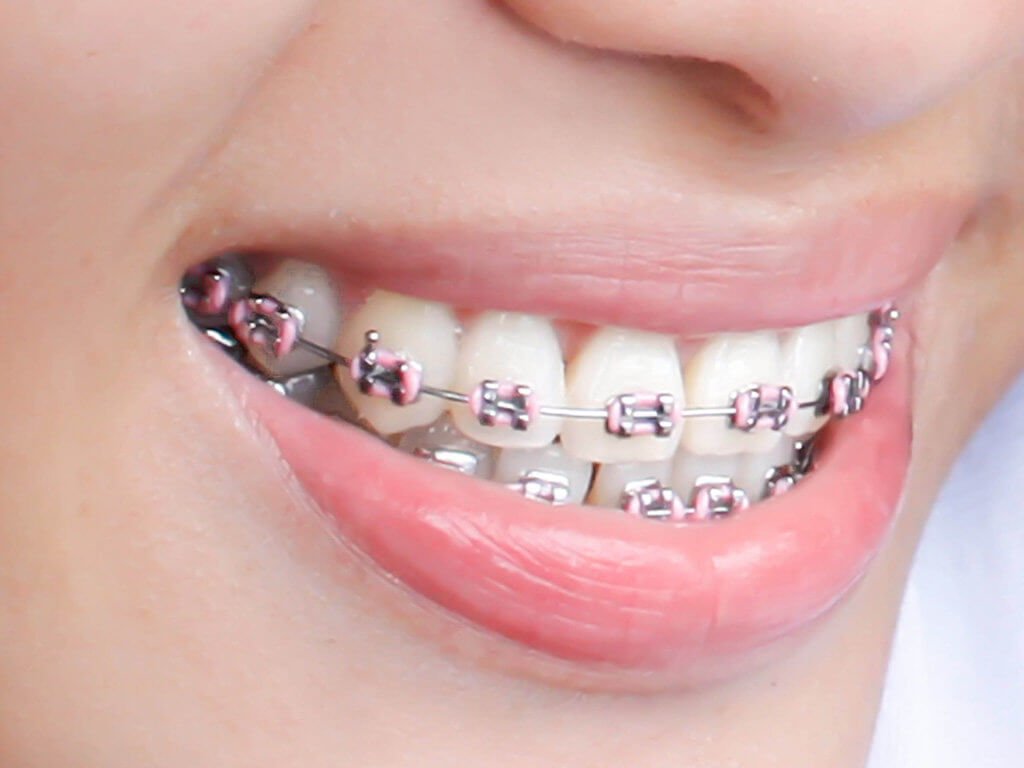 best braces colours to get