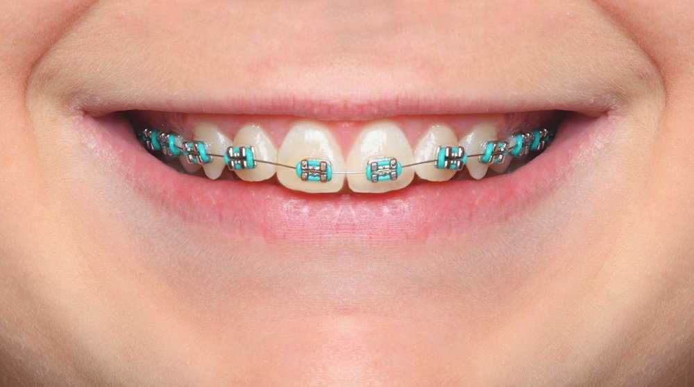 blue braces colors