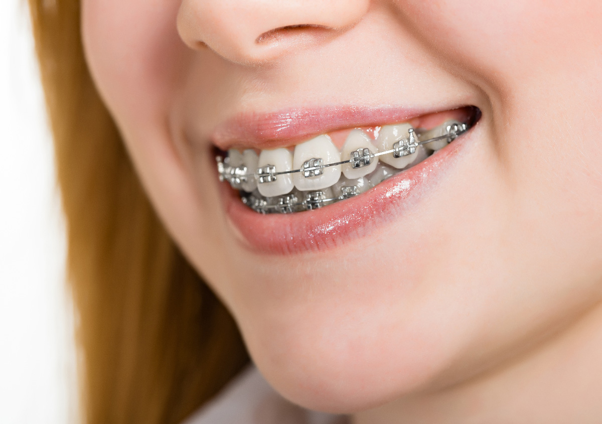 Best braces for teens