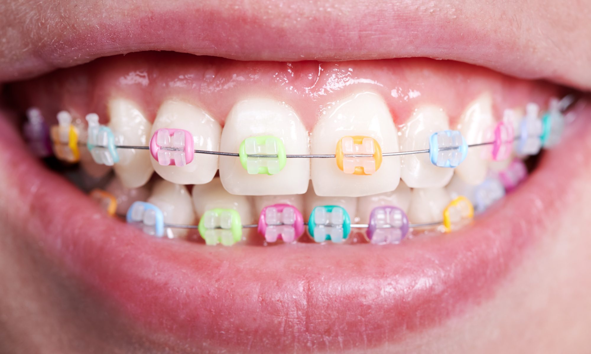 color of braces