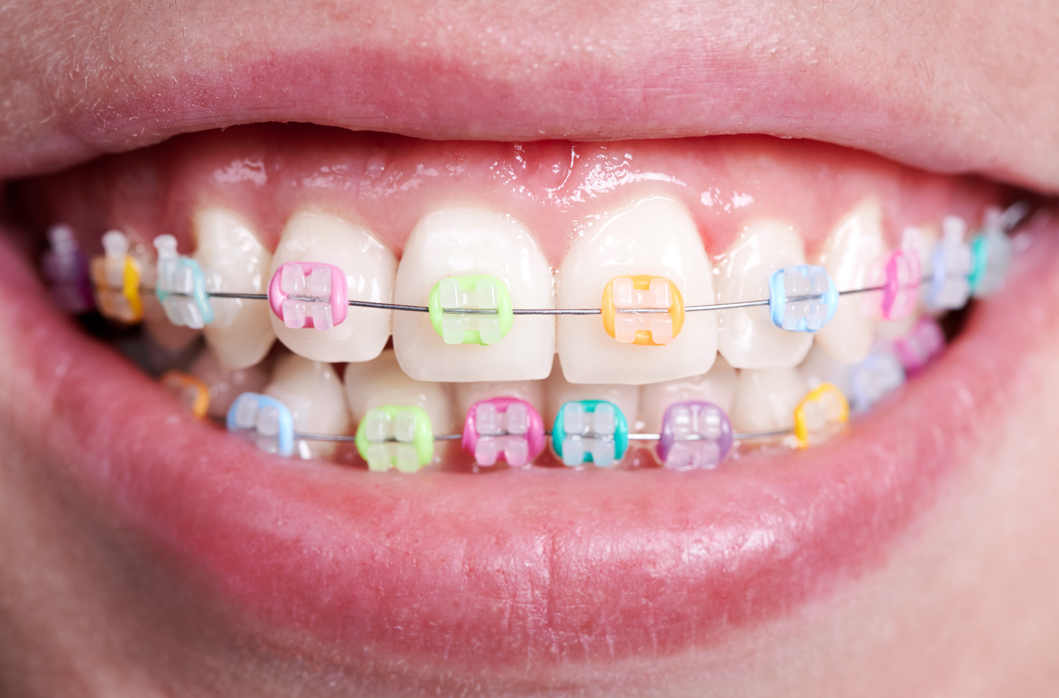 color of braces