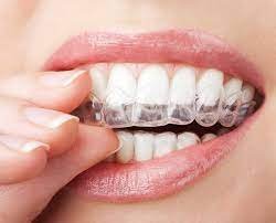 Invisalign houston