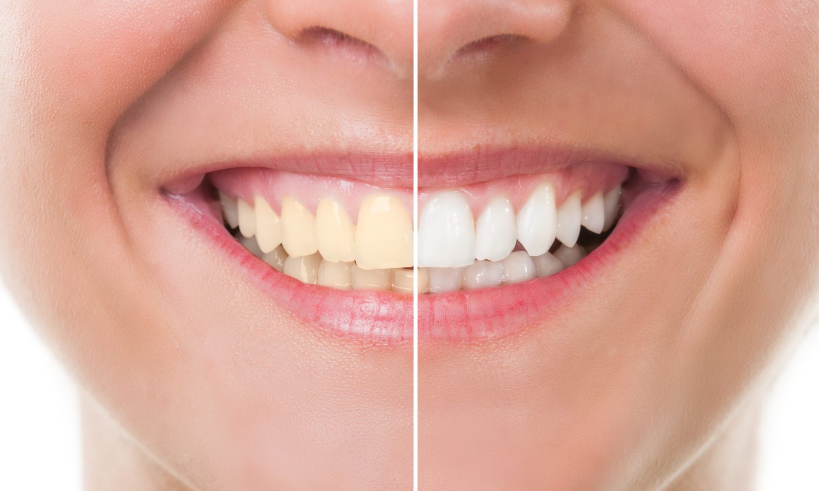 teeth whitening singapore