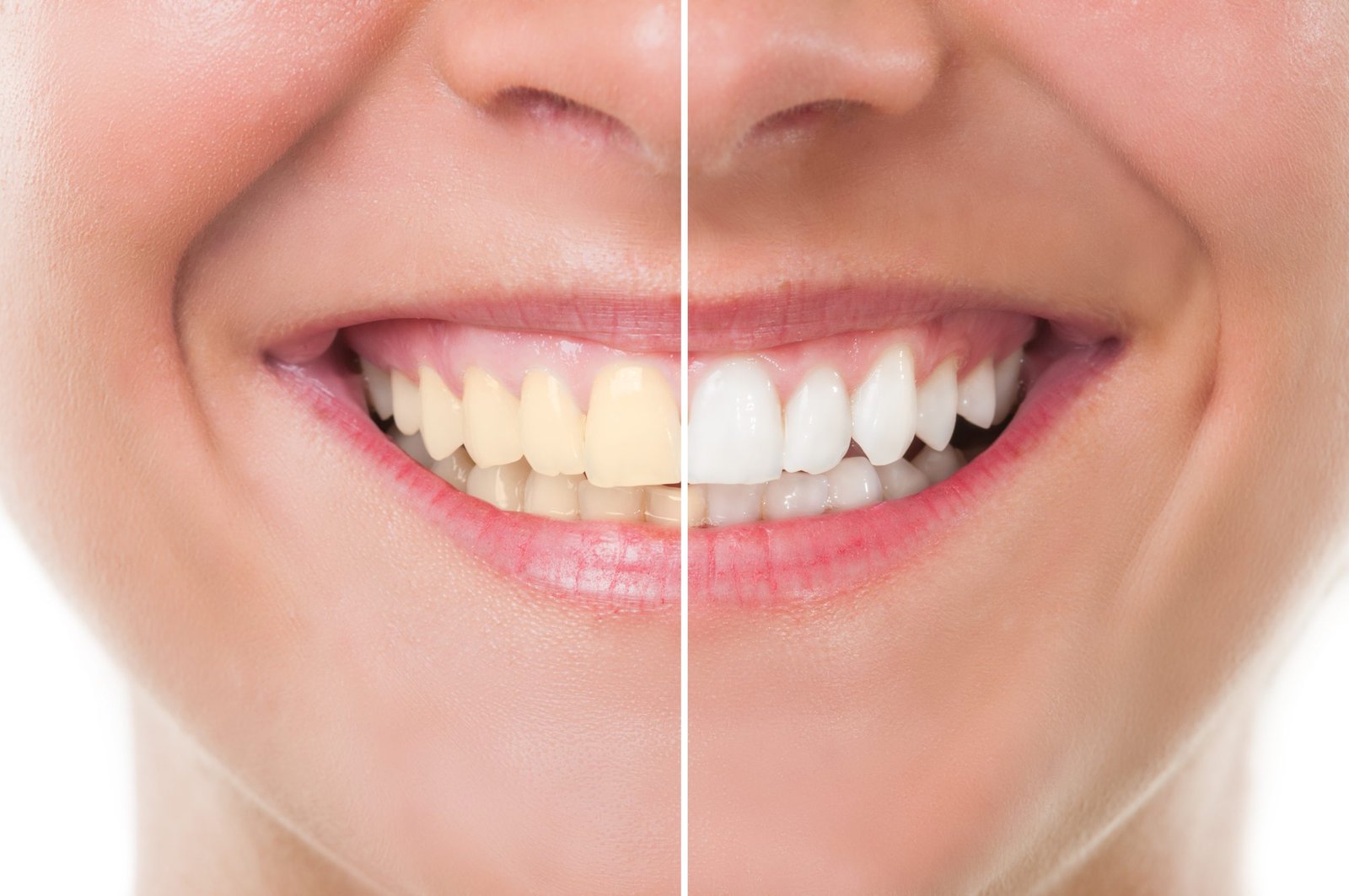 teeth whitening singapore