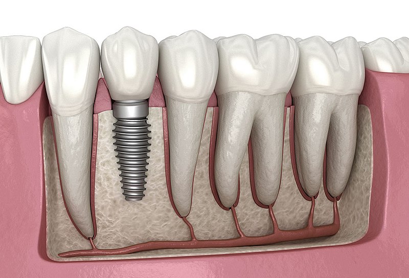 dental implant singapore