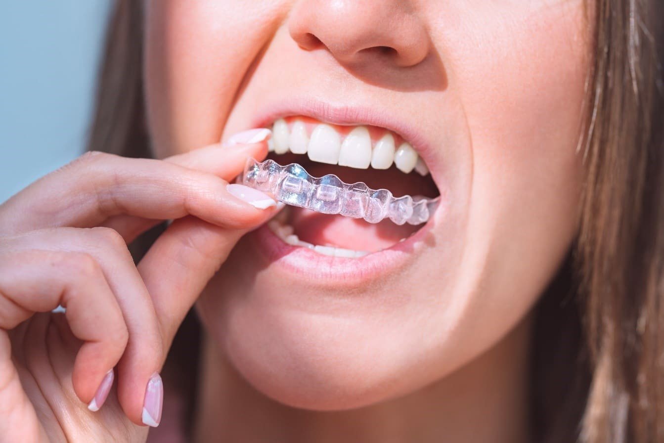 Invisalign near me