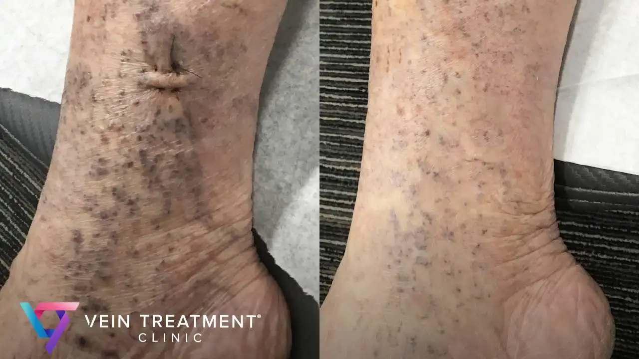 Best clinic for chronic venous insufficiency in New York
