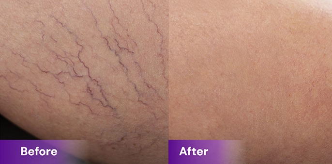 Top-rated vein clinic in NYC