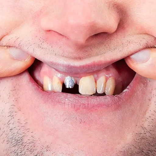 best full mouth dental implants